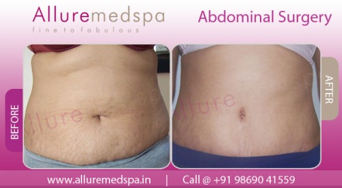 Liposuction before after India, Liposuction Surgery in Mumbai
