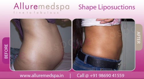 Liposuction Photos in India | Before and After Lipoplasty Photos