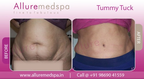 Tummy Tuck - Abdominoplasty Alluremedspa Mumbai, India