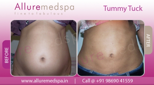 Tummy Tuck Before and After Pictures – Abdominoplasty Photos