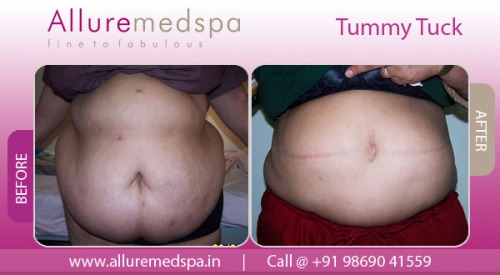 Tummy Tuck Before and After Pictures – Abdominoplasty Photos