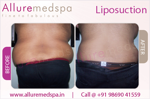 Liposuction Before and After Result Photos, images in Mumbai, India